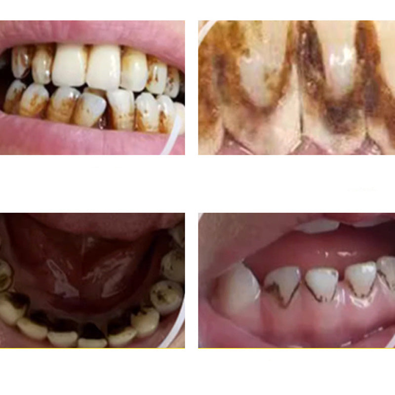 Limpiador dental ultrasónico portátil de alta eficiencia